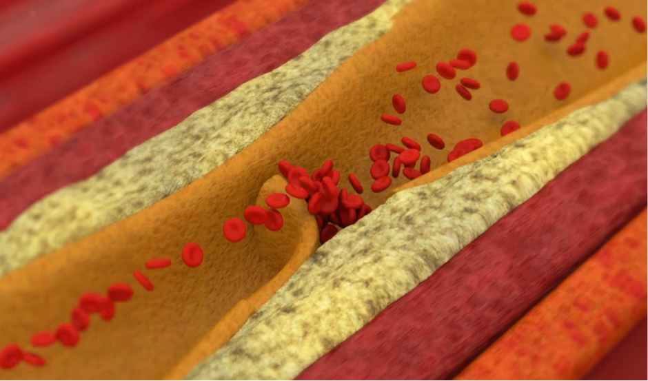 Animation showing how a coronary blockage occurs