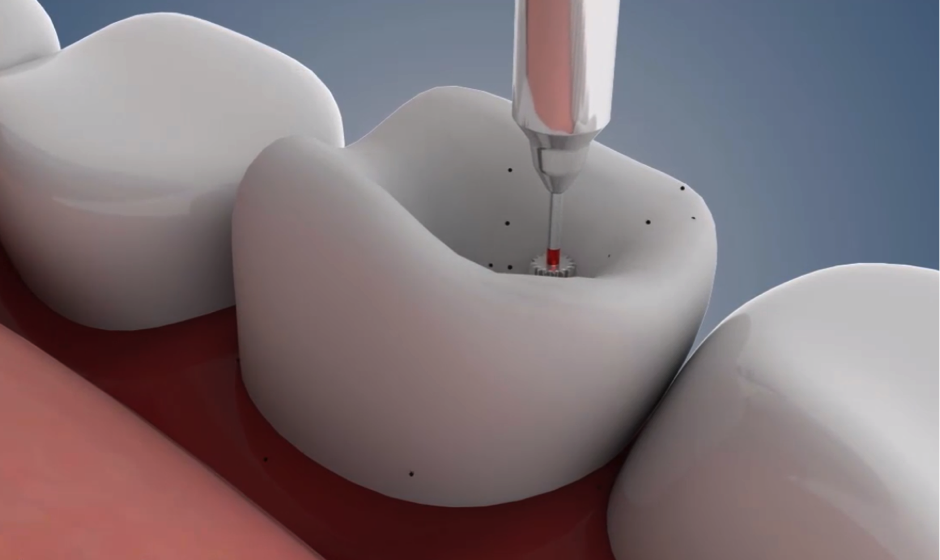 3-D animation visualizing a dental procedure